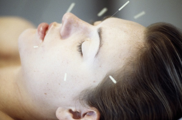 Acupuncture